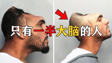 人类失去一半大脑能活吗？结果可能和你想象的不一样！